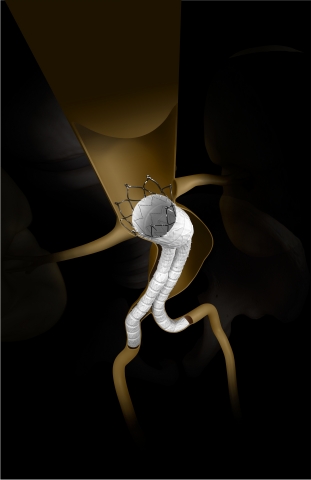 INCRAFT(R) AAA Stent Graft System (Graphic: Business Wire) 